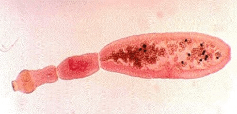 echinococcus insan vücudunda neye benziyor